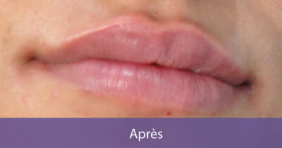 après-1