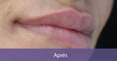 après-2
